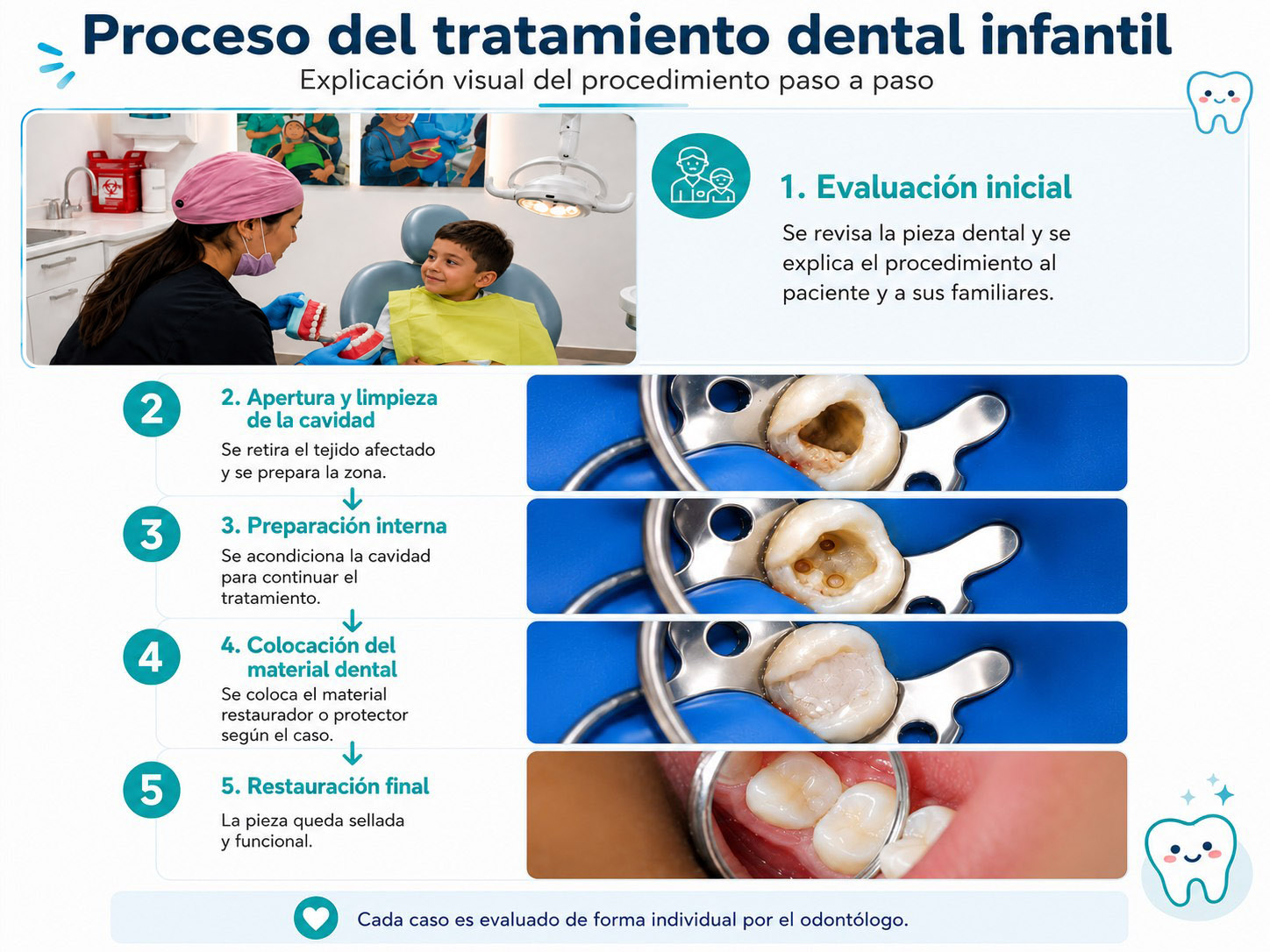 Infografía del proceso de tratamiento dental infantil en 5 pasos: evaluación inicial, apertura y limpieza de la cavidad, preparación interna, colocación del material dental y restauración final